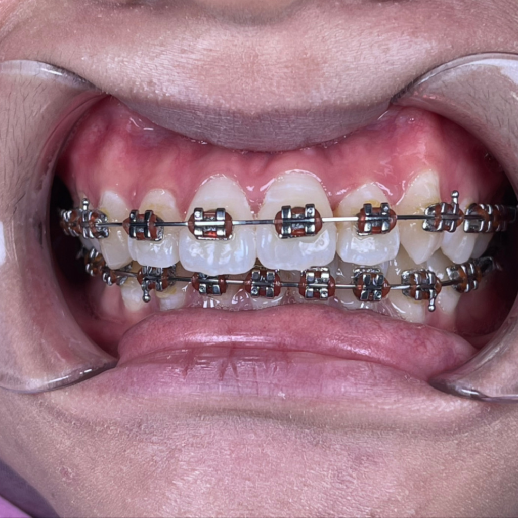 Braces treatment at Klinik Gigi Alam Dental Hutan Melintang Teluk Intan