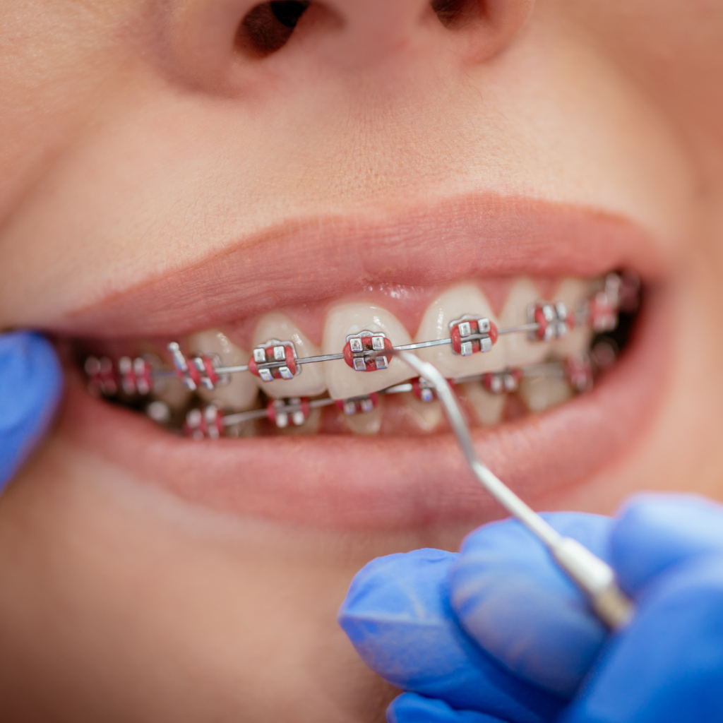 conventional braces alam dental