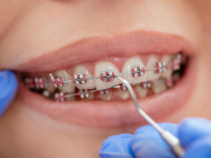 conventional braces alam dental