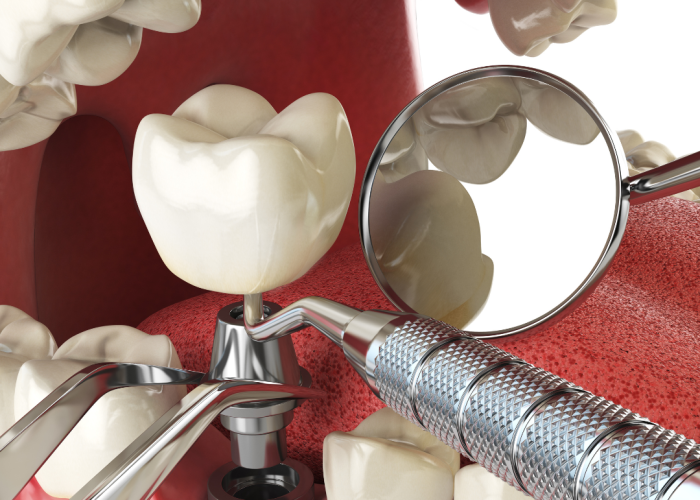 dental implant