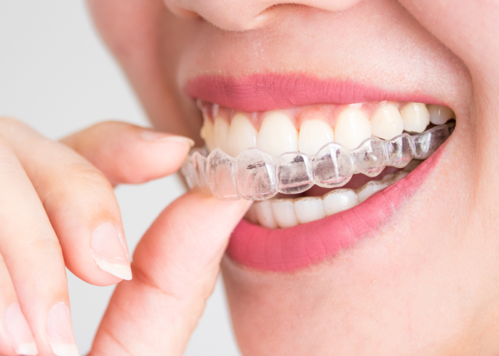 mouth guard alam dental