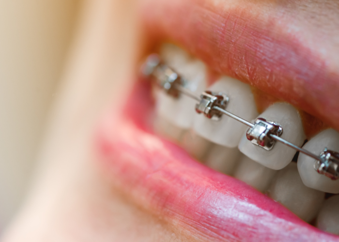 self ligating braces alam dental