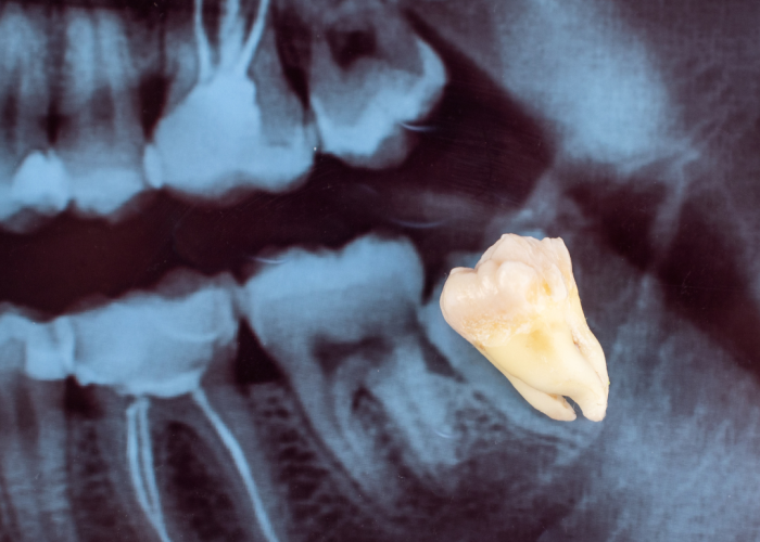 wisdom tooth removal alam dental